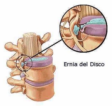 Ernia del disco: come prevenirla con l'allenamento