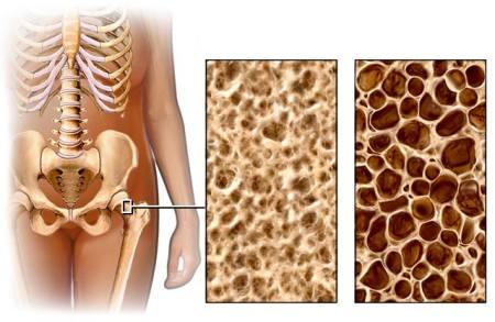 L'osteoporosi si combatte a tavola