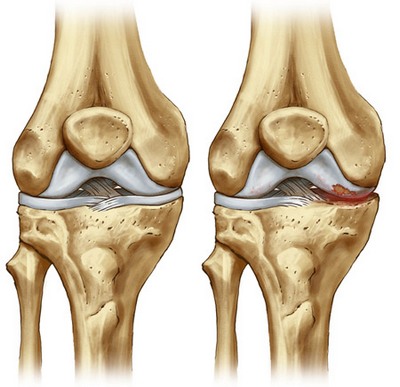 La lesione del menisco