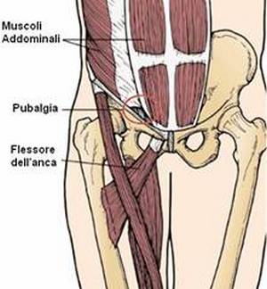 Pubalgia, cause e cure