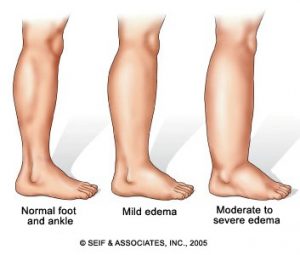 edema