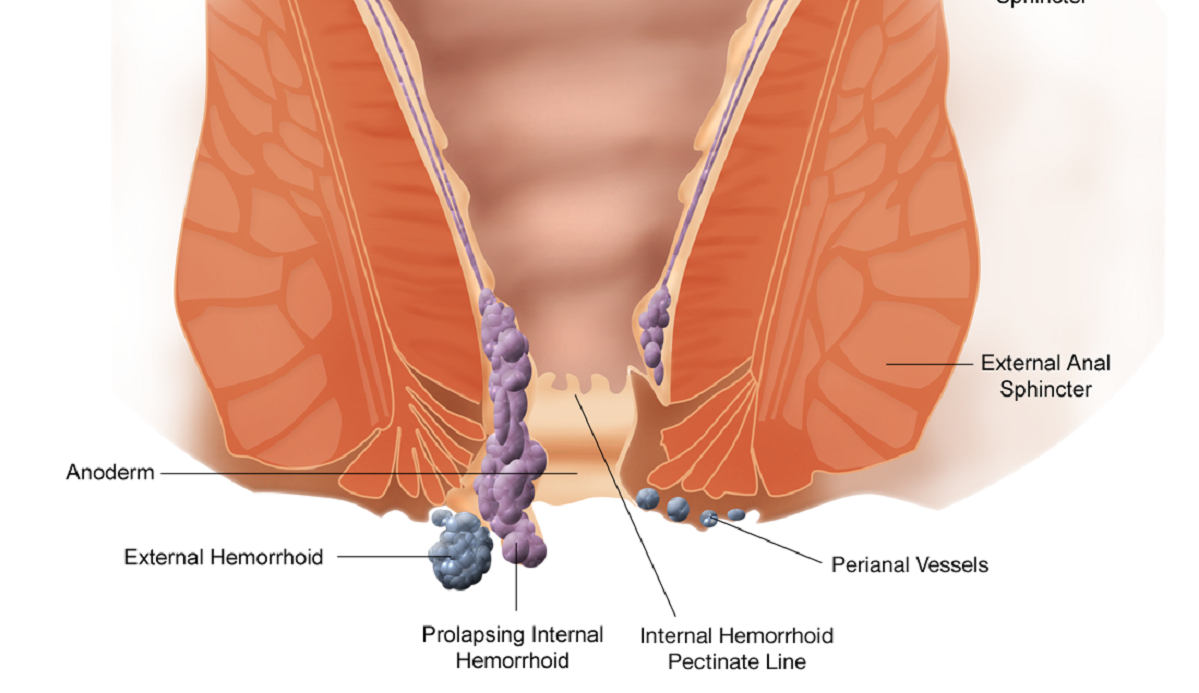 alleviare le emorroidi